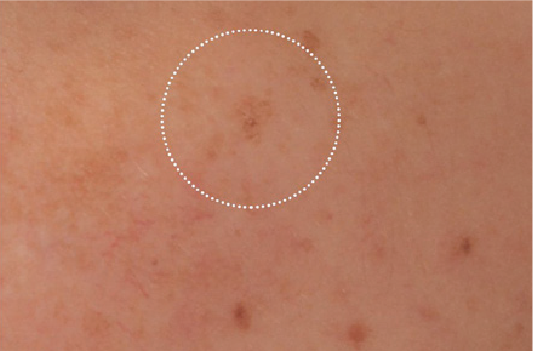 Pigmented lesions before diode laser treatment